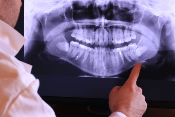 Best Emergency Dental Care for Abscessed Tooth in Packanack Lake, NJ