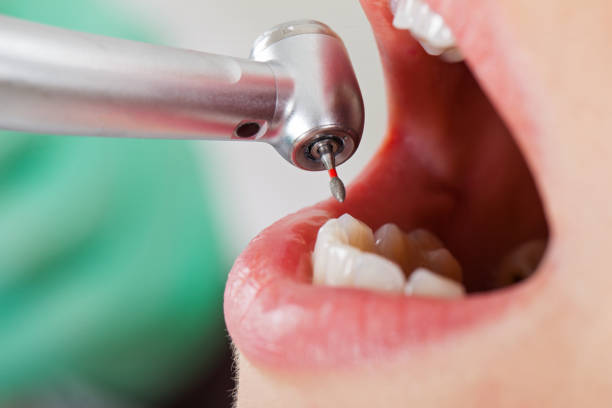 Best Emergency Dentist for Knocked-Out Tooth in Packanack Lake, NJ
